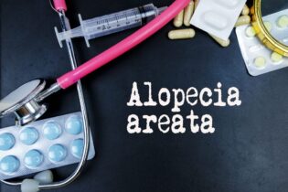 Was ist Alopecia Areata und wie wird es behandelt?